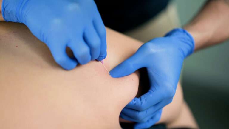Dry needling / trigger points